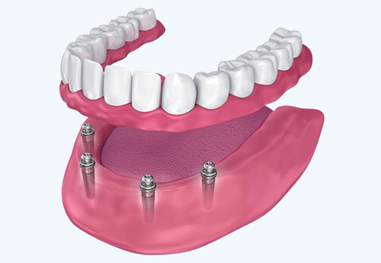 Benefits of All-On-4®
