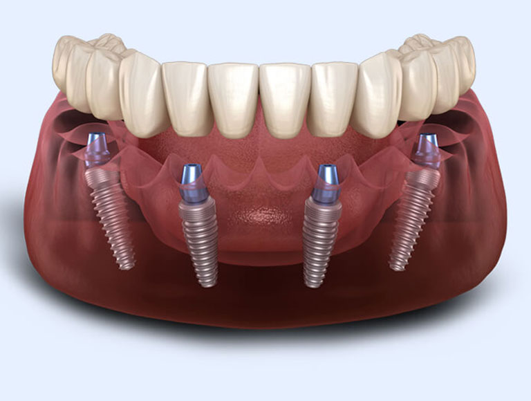 The All-On-4® Technique