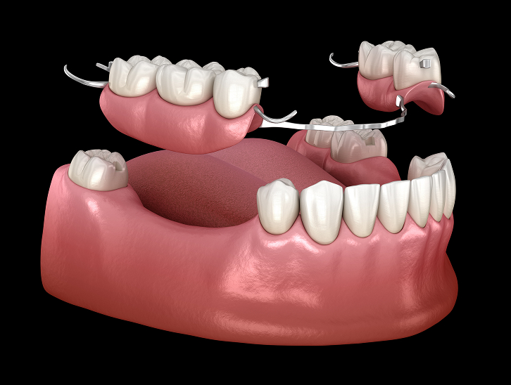 Dentures and Partials
