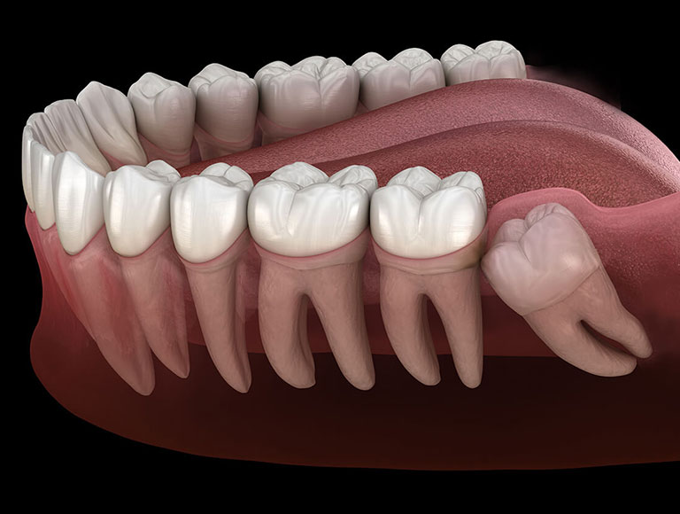 Wisdom Teeth Removal