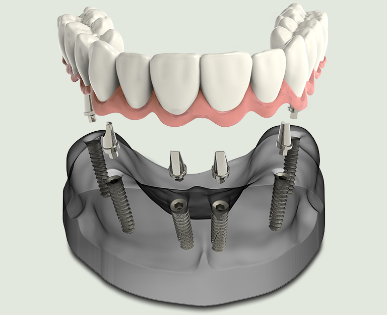 Benefits of Teeth-In-A-Day