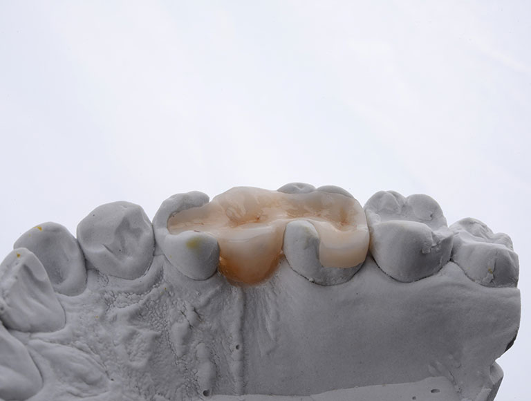 Durable Solutions for Tooth Restoration
