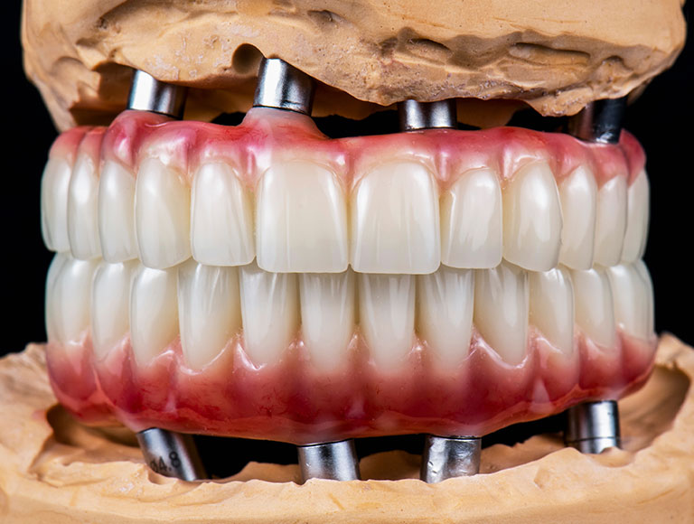 Full Mouth Reconstruction